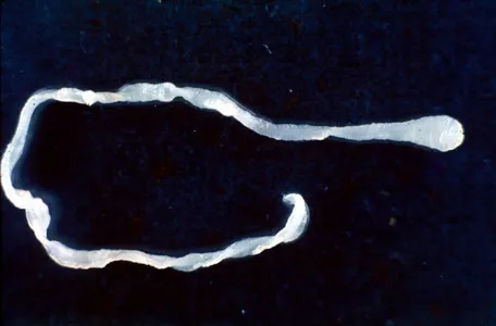Surgeons Discover Living Worm During Routine Hernia Surgery