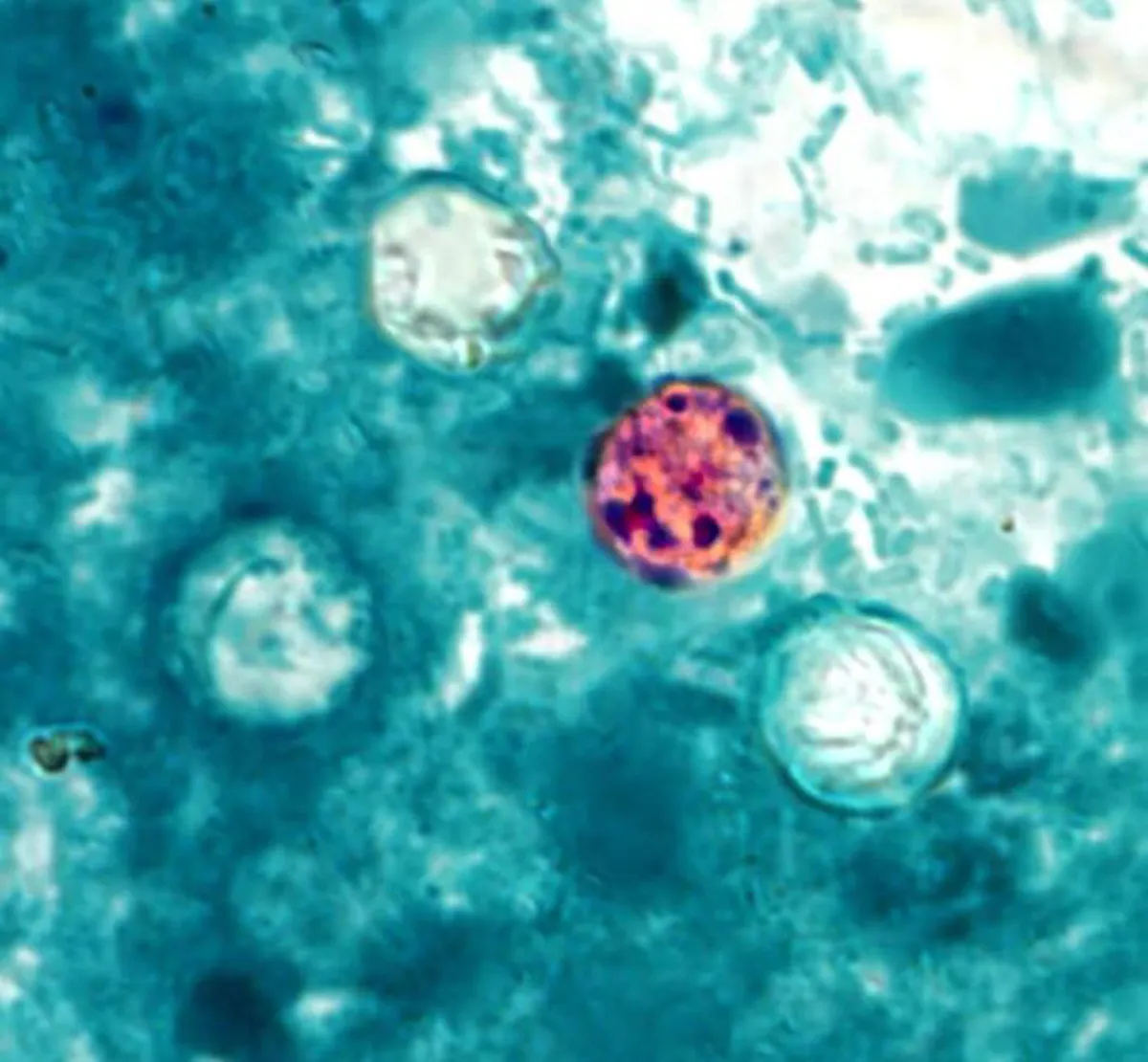 Surge in Cyclospora Outbreaks: FDA Investigates 72 New Cases