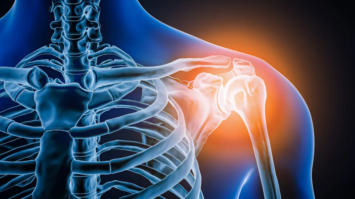 The Mysterious Case of Milwaukee Shoulder Syndrome: A Rare Medical Mystery