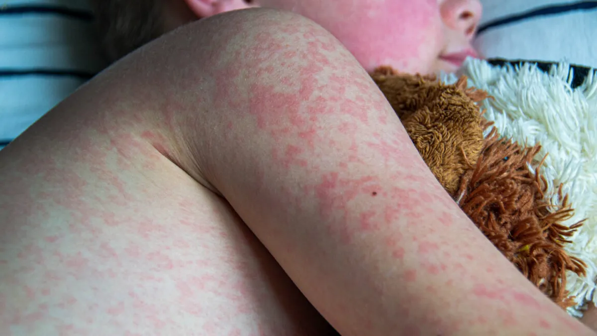 Measles Outbreak in Pennsylvania: A Wake-Up Call for Vaccination Awareness